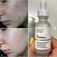 The Ordinary Niacinamide 10% + Zinc 1% – 30ml by Click N Buy